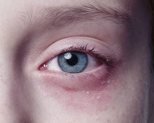 2022-1130-Traumas-oculares-Blog Lesões oftalmológicas por Zika Vírus